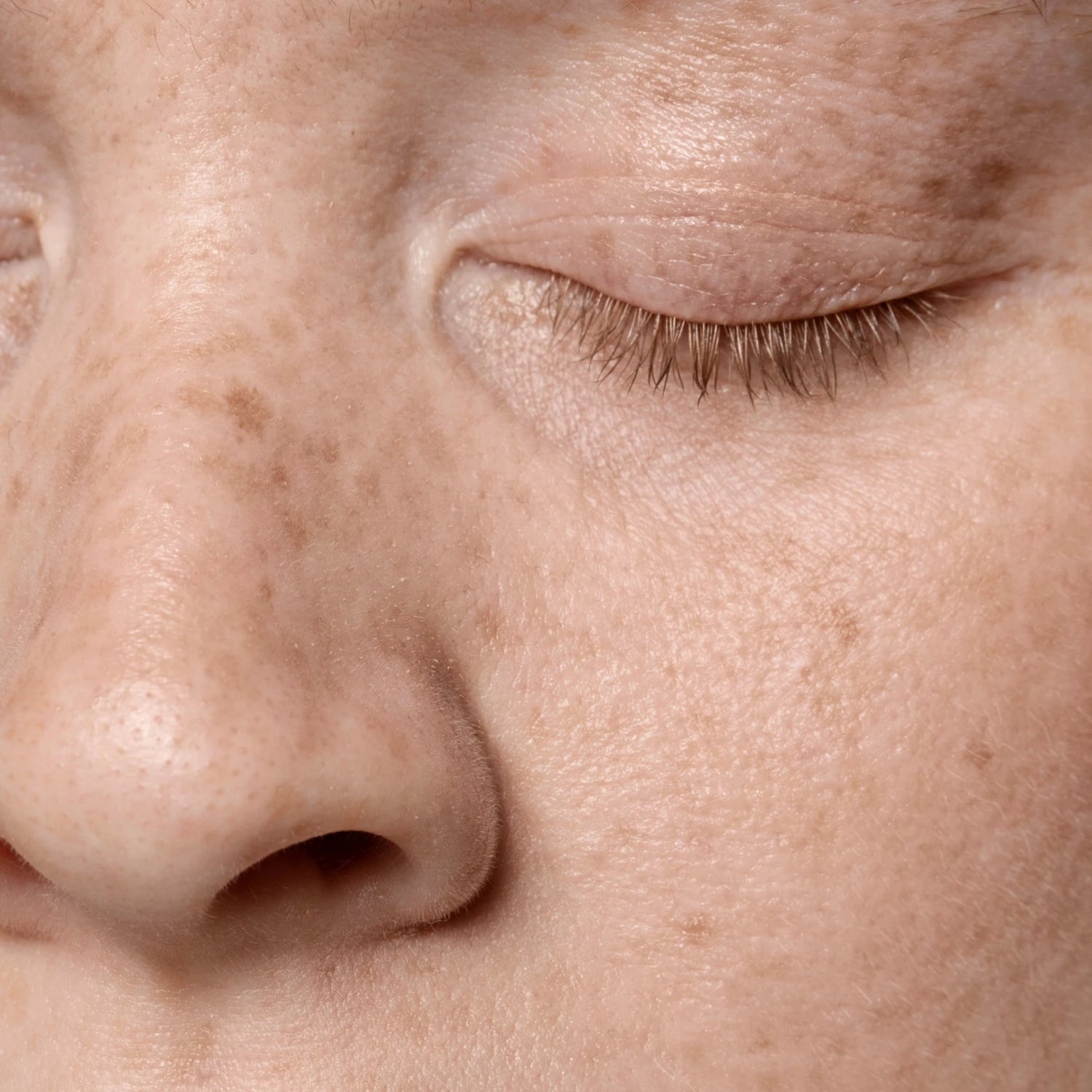 Gros plan sur le grain de peau et taches de rousseur, rendu peau terne avant exfoliation visage (acide glycolique / AHA).