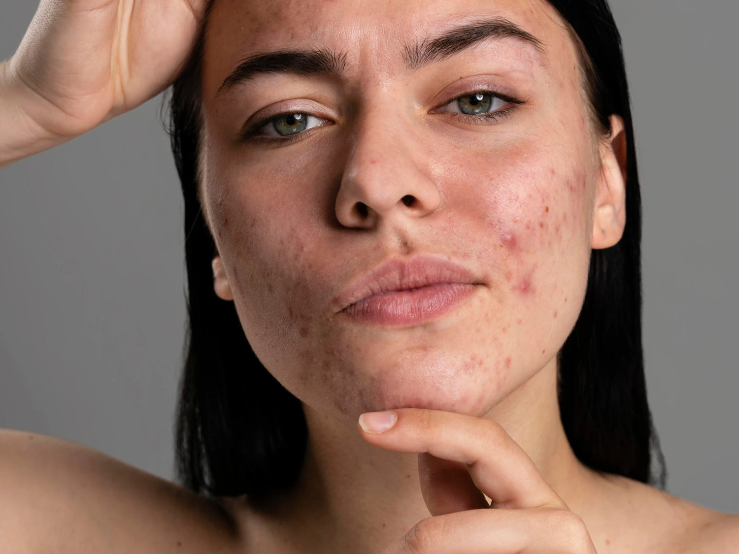 Portrait d’une femme à la peau mixte sujette aux imperfections visibles et aux rougeurs du visage